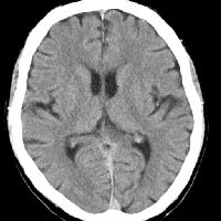 /dateien/0,1297515618,CT-Schadel-NB-Weichteilfenster