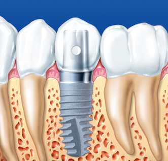 /dateien/uh55935,1251974891,implantat 005