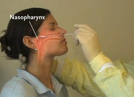 nasopharyngeal-culture 2