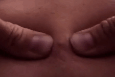 pimpleburst