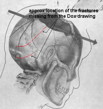 t61eea5 dox missing fractures