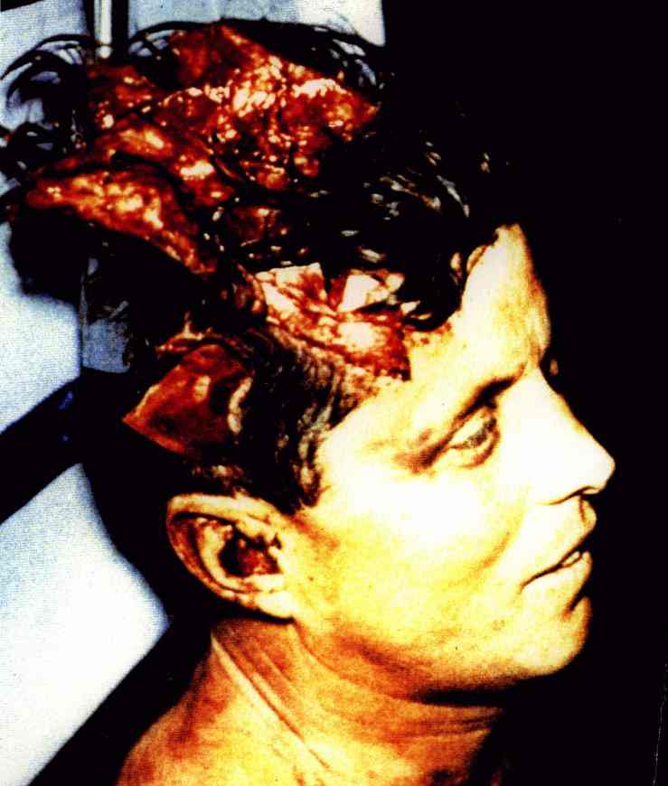 Tippit autopsy