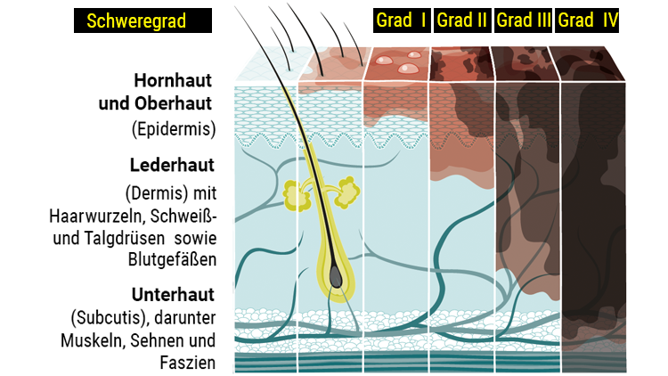 schweregrad-von-brandverletzungen der ha