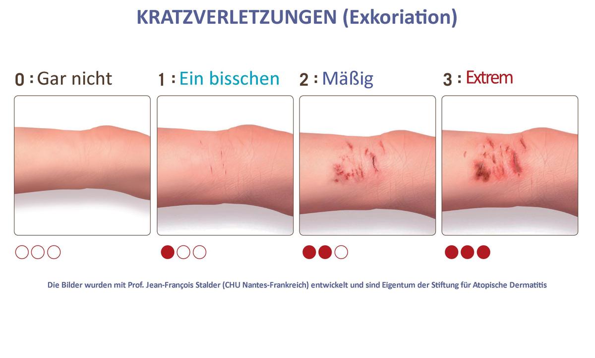 kratzverletzungen exkoriation