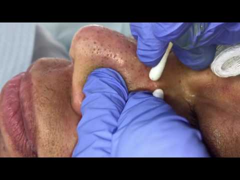 Youtube: Managing Ethnic skin (Extractions Part 3)