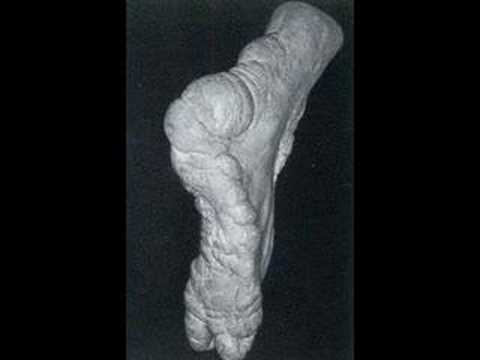 Youtube: Joseph Merrick......The Elephant Man